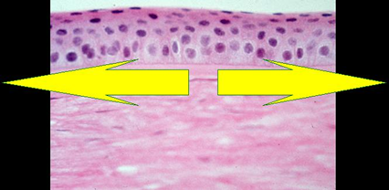 Перераспределение клеток эпителия под действием ОК-линзы.